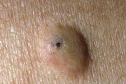 example-of-cyst