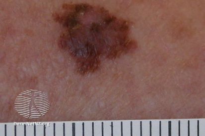 melanoma2-WatermarkedWyJXYXRlcm1hcmtlZCJd