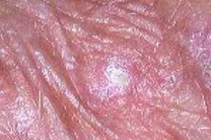 actinic-keratosis-2